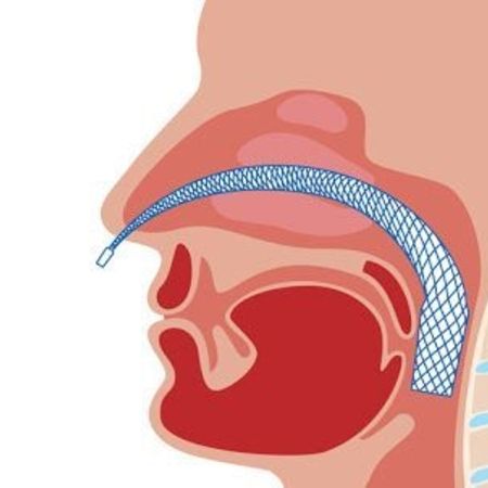Illustration of a nasal stent supporting the airway in the nasopharynx.