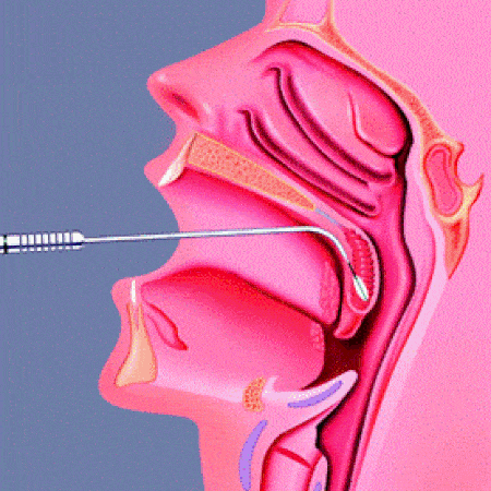 Lateral illustration of a medical procedure in the throat using an instrument.