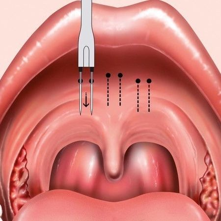 Illustration of a palatal injection with marked points indicating the treatment area.