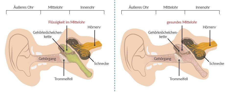 Comparative illustration of the human ear: On the left, a middle ear with fluid accumulation; on the right, a healthy middle ear. Labels highlight structures such as the ossicles, auditory nerve, and eardrum.