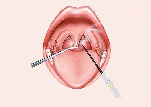 Illustration of a surgical procedure in the palate area using two medical instruments.