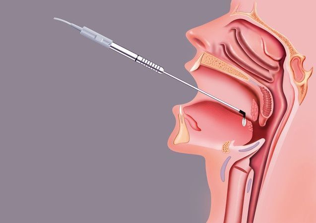 Hyperplasia of the tongue base